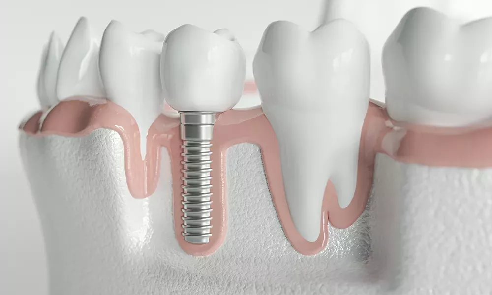 Difference between mini dental implants and traditional dental implants