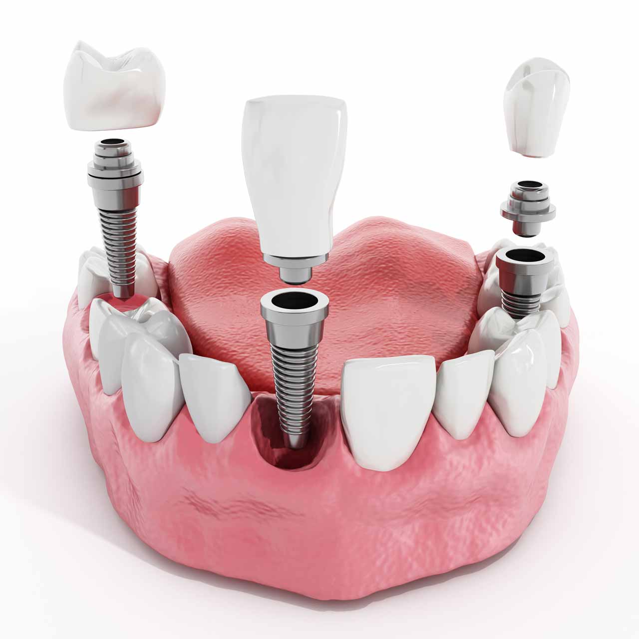 Difference Between Mini Dental Implants And Traditional Dental Implants, Distinction of Mini Dental Implants And Conventional Dental Implants, Contrasting Mini Dental Implants And Traditional Dental Implants, Disparity Between Mini Dental Implants And Traditional Dental Implants, Comparative Analysis of Mini Dental Implants And Traditional Dental Implants, Variances in Mini Dental Implants And Traditional Dental Implants, Divergence Between Mini Dental Implants And Traditional Dental Implants, Miniature Dental Implants vs Conventional Dental Implants, Mini Dental Implants vs Regular Dental Implants, Unique Aspects of Mini Dental Implants And Traditional Dental Implants, Contrasts in Mini Dental Implants And Traditional Dental Implants, Notable Differences Between Mini Dental Implants And Traditional Dental Implants, Miniature Implants vs Traditional Dental Implants, Distinct Characteristics of Mini Dental Implants And Traditional Dental Implants, Comparative Overview Mini Dental Implants vs Traditional Dental Implants, Dental Implant Variations Mini vs Traditional, Dissimilarity Between Mini Dental Implants And Traditional Dental Implants, Mini Dental Implants Compared to Traditional Dental Implants, Distinctive Traits of Mini Dental Implants And Traditional Dental Implants, Mini vs Regular Dental Implants Unveiling the Differences, Key Contrasts Between Mini Dental Implants And Traditional Dental Implants, Mini Dental Implants vs Classic Dental Implants, Miniature Implants vs Traditional Dental Implants A Closer Look, Examining Mini Dental Implants And Traditional Dental Implants, Varied Features of Mini Dental Implants And Traditional Dental Implants